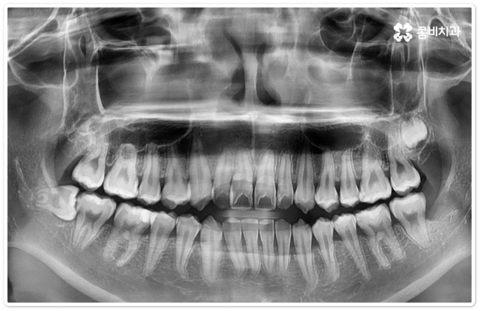 누운사랑니발치 이모저모 알아봐요 관련 이미지 7