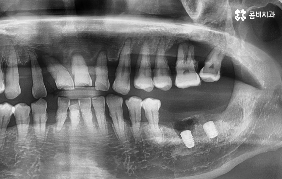 건강보험 임플란트 적용 받기 전에 알아두세요 관련 이미지 2