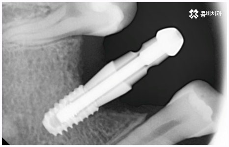 임플란트 종류 어떤게 맞을까요? 관련 이미지 8