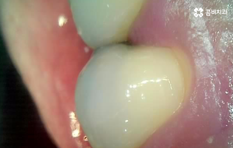 어금니 충치 깨짐 판단기준부터 세워보세요 관련 이미지 10