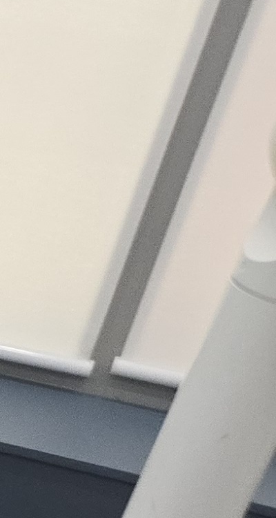 어금니 임플란트 안하면 후회하게 되는걸까 관련 이미지 32