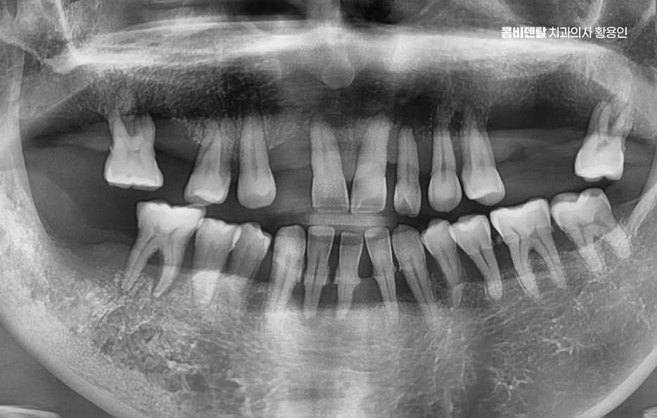 50대임플란트 꼼꼼하게 따져봐야할 포인트는 관련 이미지 1