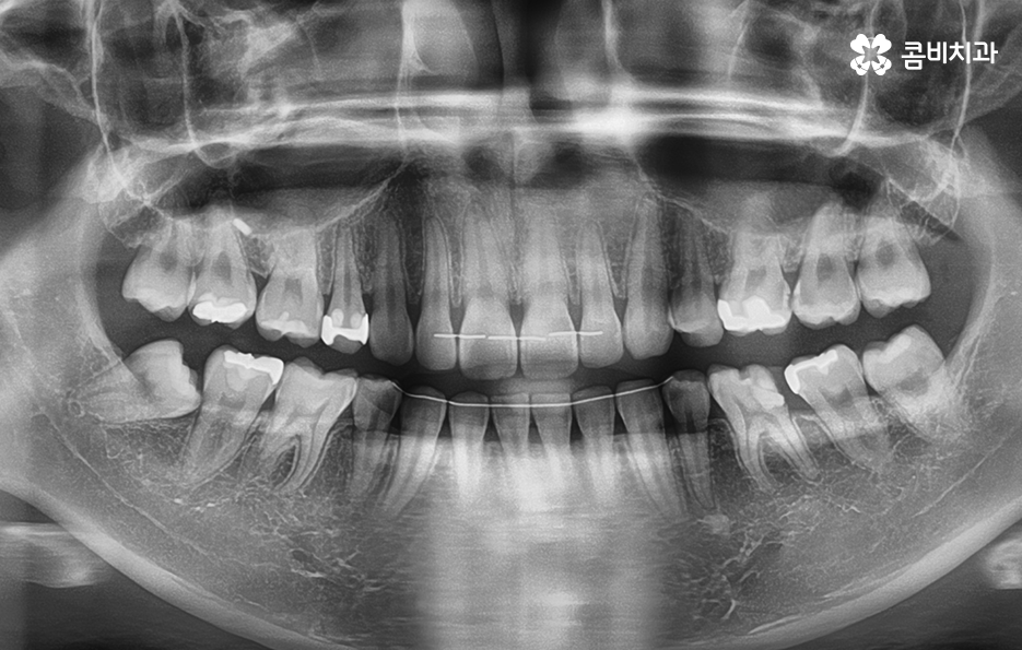 치아 사이 충치 까다로운 이유부터 알아보시죠 관련 이미지 1