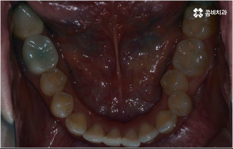 성인 치아교정 기간 걱정이 앞서나요 관련 이미지 6