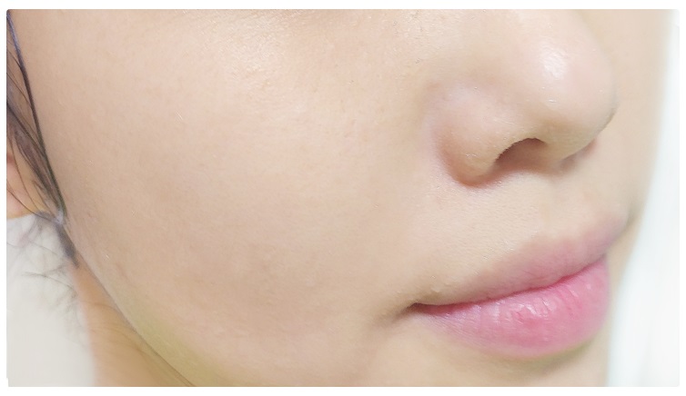 화이트헤드 제거 꿀팁공개! 관련 이미지 7