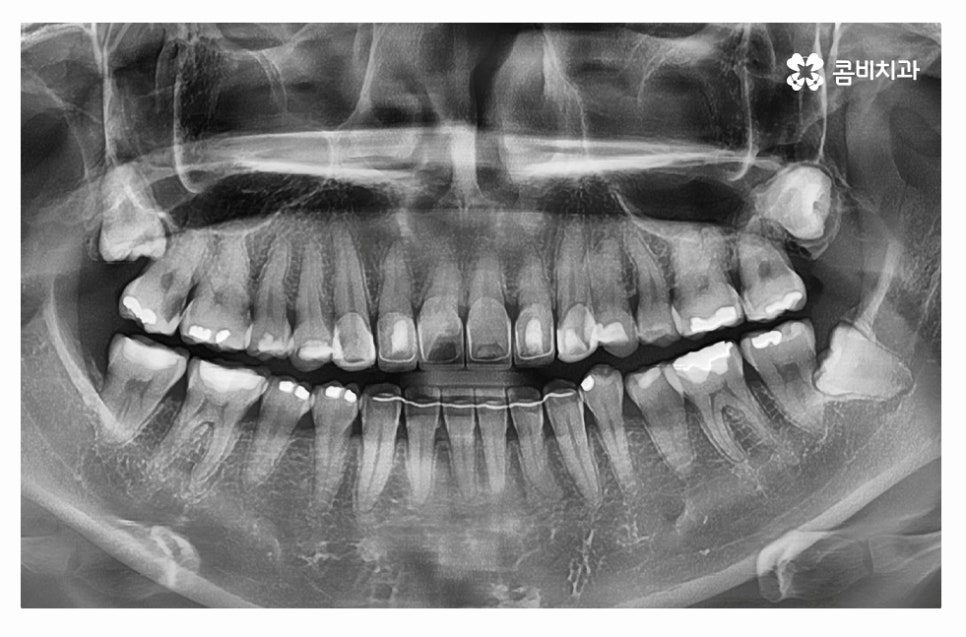 누운사랑니발치 언제 뽑을지 고민이라면 관련 이미지 4