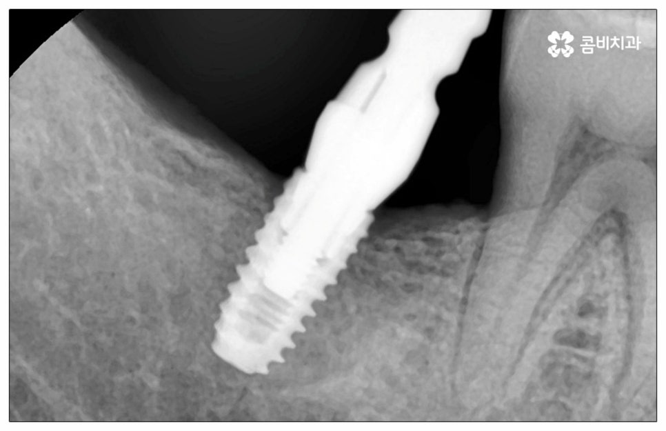 건강보험임플란트 혜택받아 보세요 관련 이미지 3
