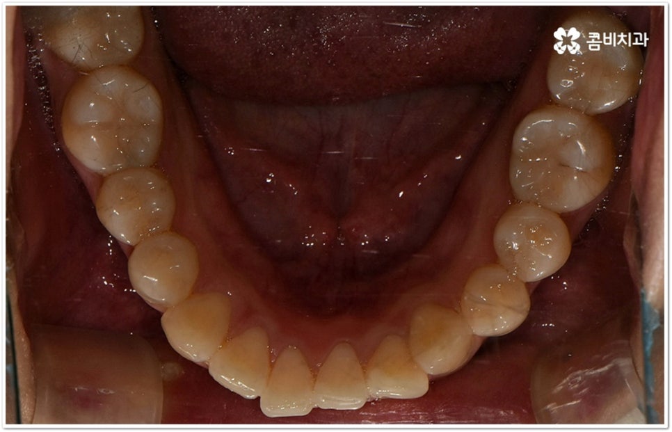 덧니부분교정 시작하려면 관련 이미지 13