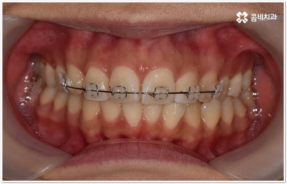 덧니부분교정 시작하려면 관련 이미지 9