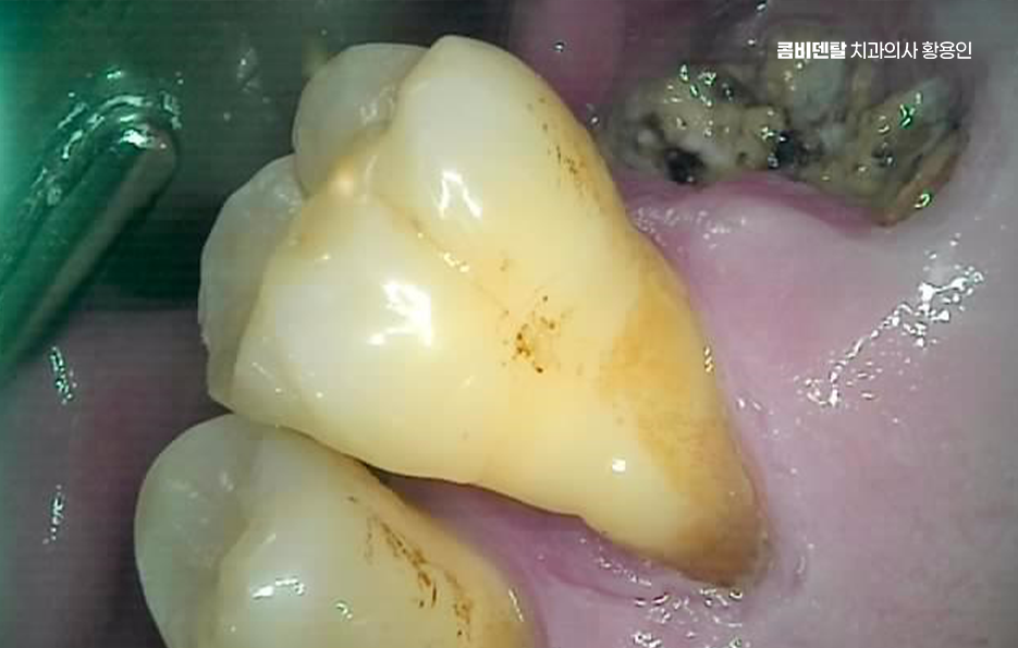 어르신 임플란트 지원 현명하게 활용하려면 관련 이미지 2