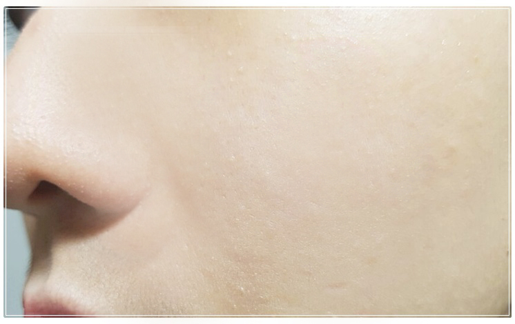 블랙헤드없애는법 더 강력하게 돌아왔다 관련 이미지 11