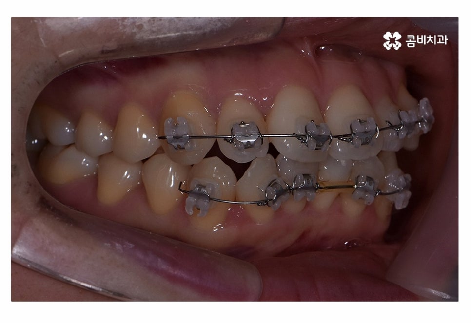 치아부분교정 나도 해당될지 궁금하다면 관련 이미지 6
