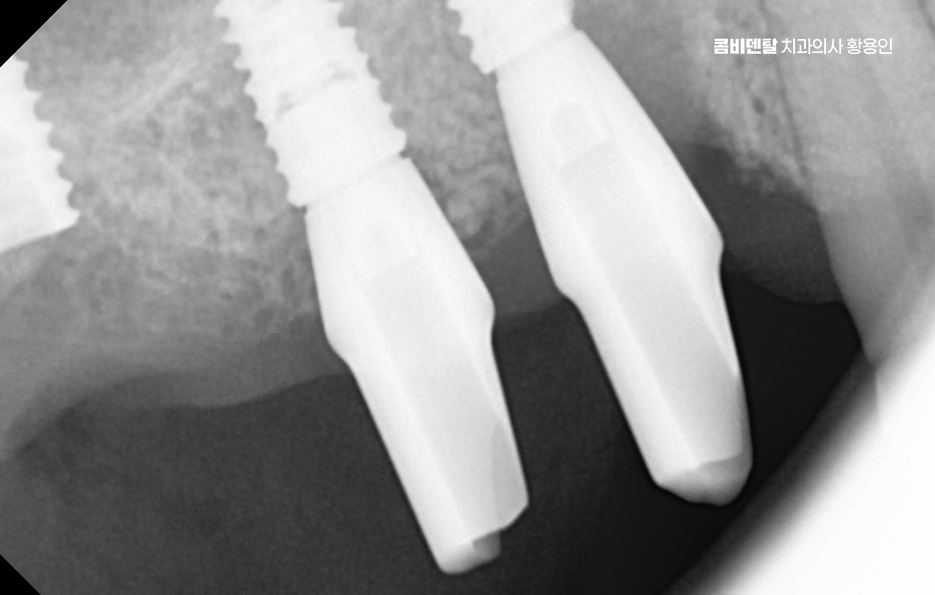 어금니 발치후 임플란트 안하면 어떻게 변하는걸까 관련 이미지 10