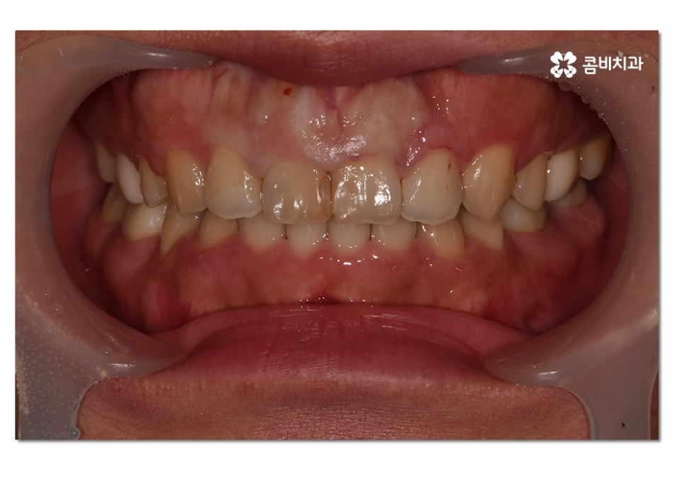 치주질환 치료의 중요성과 치은절제술이 활용된 사례 관련 이미지 1