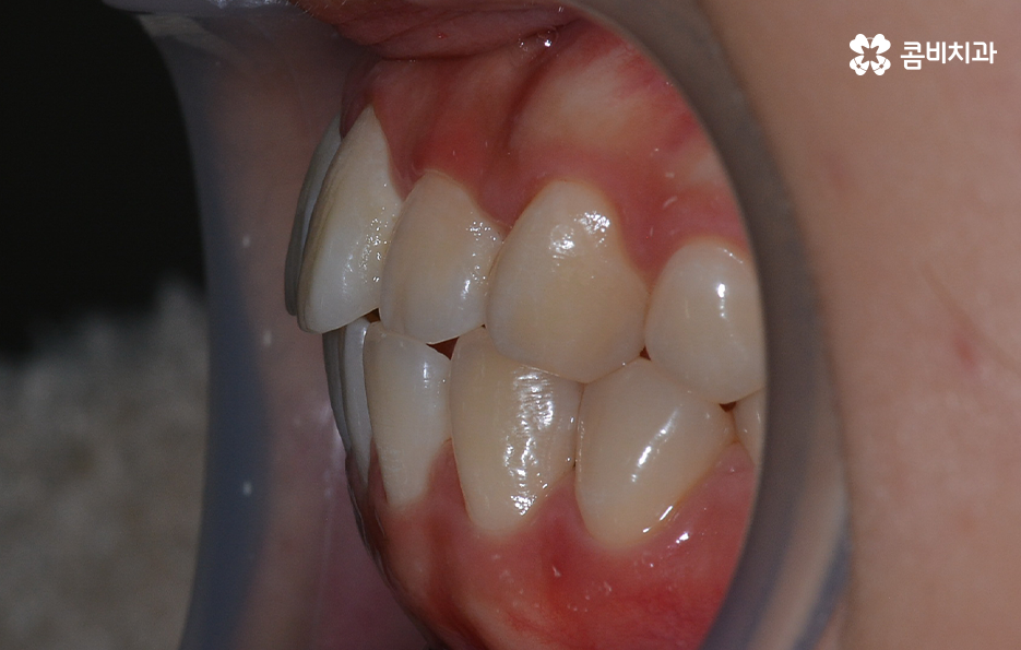 돌출입발치교정 기대해봐도 될까요 관련 이미지 4