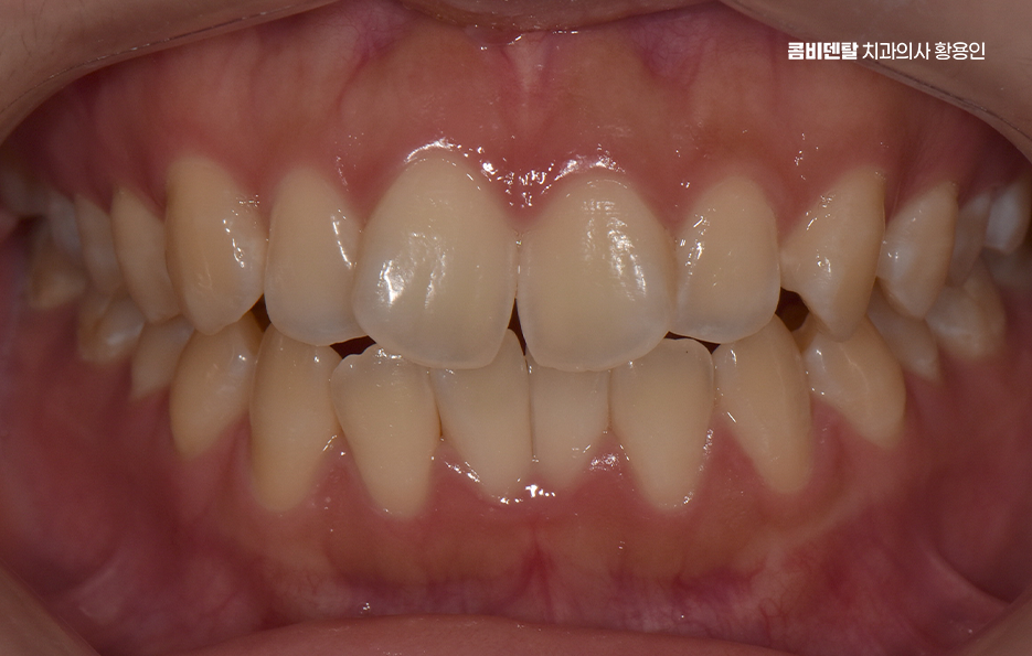 How Can You Determine the Duration of Front Teeth Orthodontic Treatment? image 2