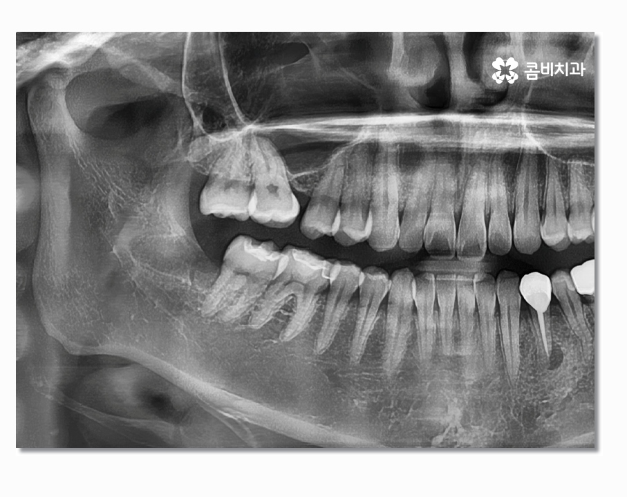 부분매복사랑니 언제 뽑아야 할까 관련 이미지 5
