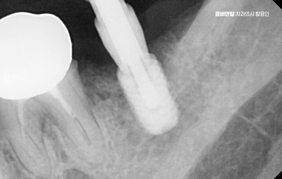 치아 발치 후 임플란트 언제부터 준비할까 관련 이미지 8