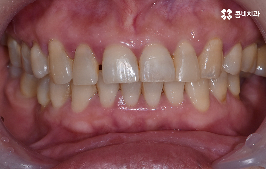 임플란트 해야 하는데 치아교정이 하고 싶다면 관련 이미지 2