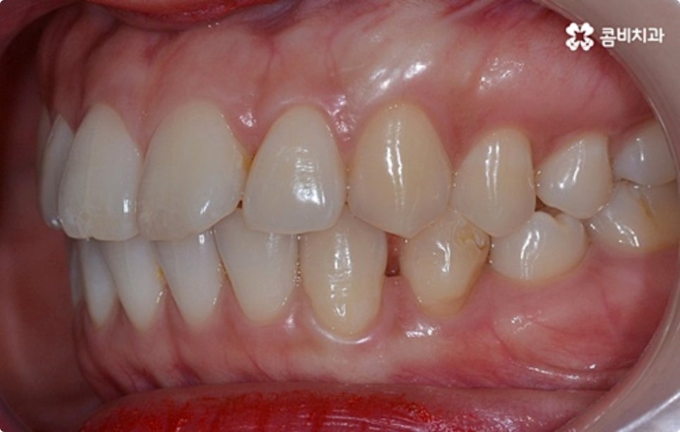 직장인치아교정 어떻게 시작하나요? 관련 이미지 7