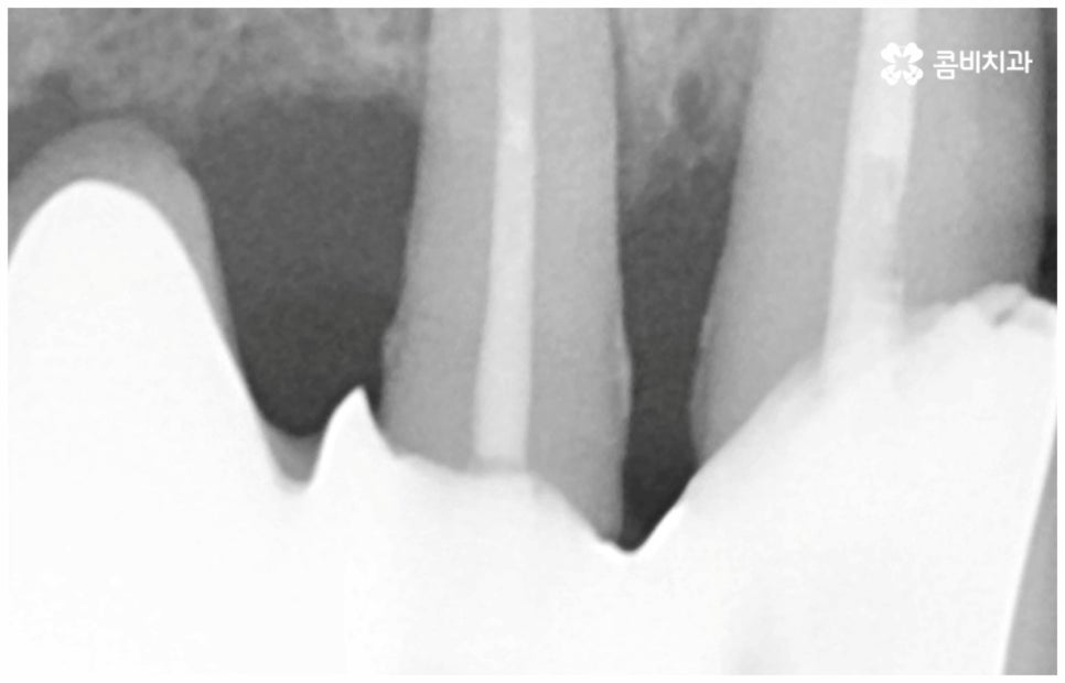 임플란트수명 연장하려면? 관련 이미지 8