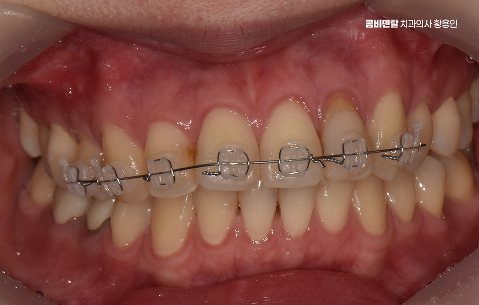 앞니 틀어짐 부분교정 얼마나 걸릴까 관련 이미지 6