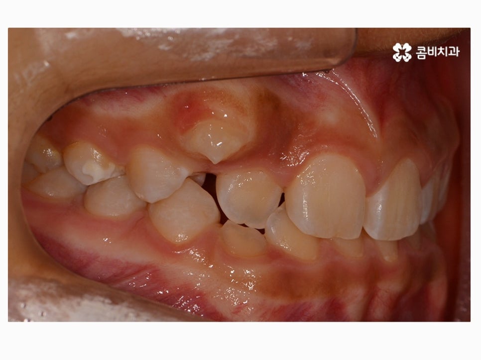과개교합교정 어릴때 고쳐주면 좋은 사례 관련 이미지 3