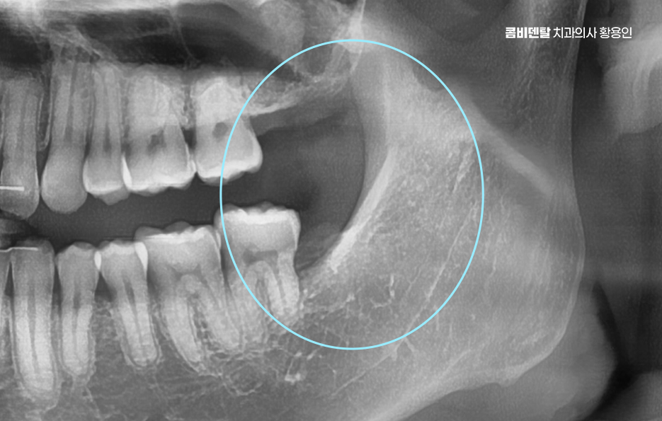완전매복사랑니 발치 대학병원 꼭 가야하나요 관련 이미지 7
