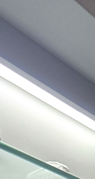 완전매복사랑니 발치 대학병원 꼭 가야하나요 관련 이미지 14