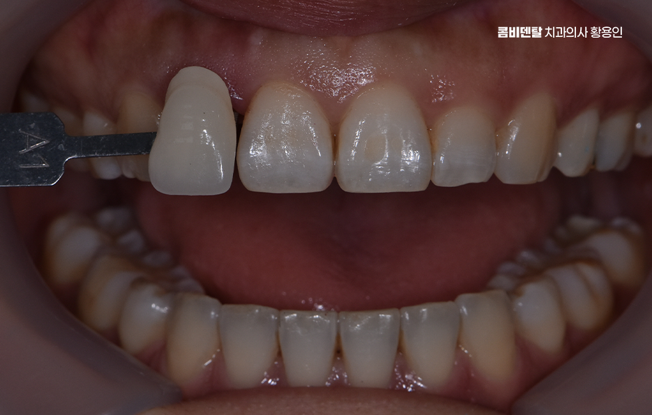 앞니 올세라믹 이건 알고 시작하세요 관련 이미지 4