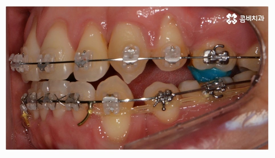 클리피씨교정 올바르게 판단하려면 관련 이미지 12