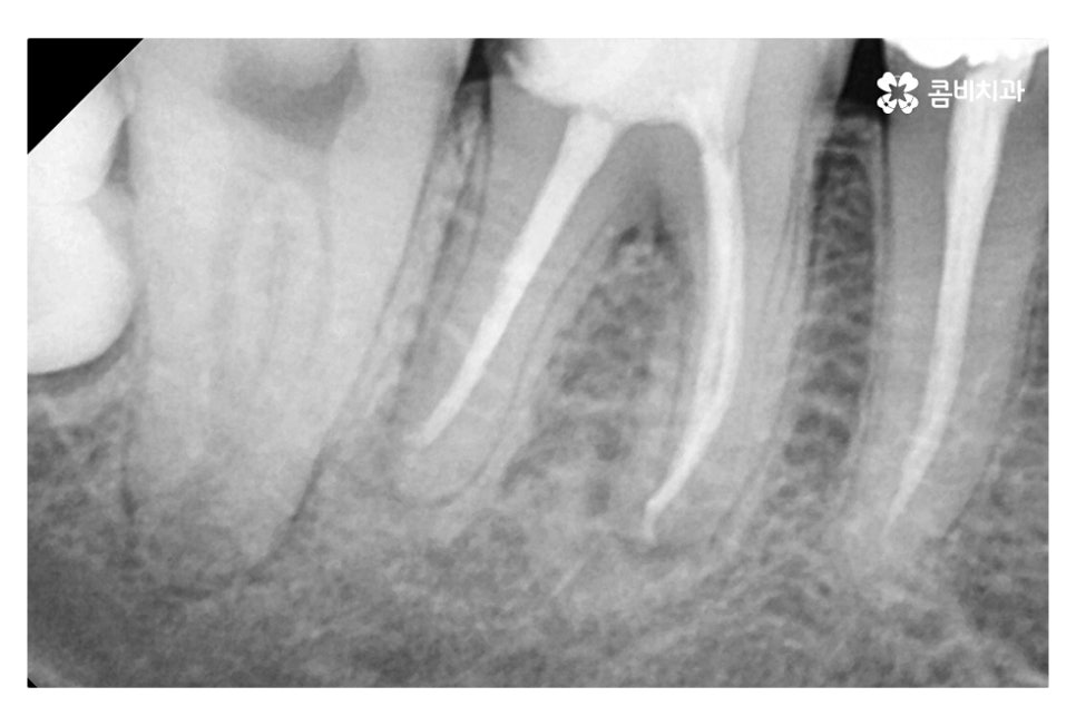 신경치료 후 크라운 시기를 놓치지 않으려면 관련 이미지 5