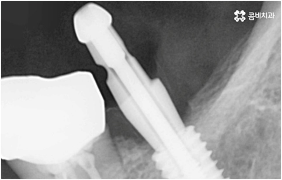 어금니임플란트 살펴볼 사항들은 무엇인가요? 관련 이미지 13