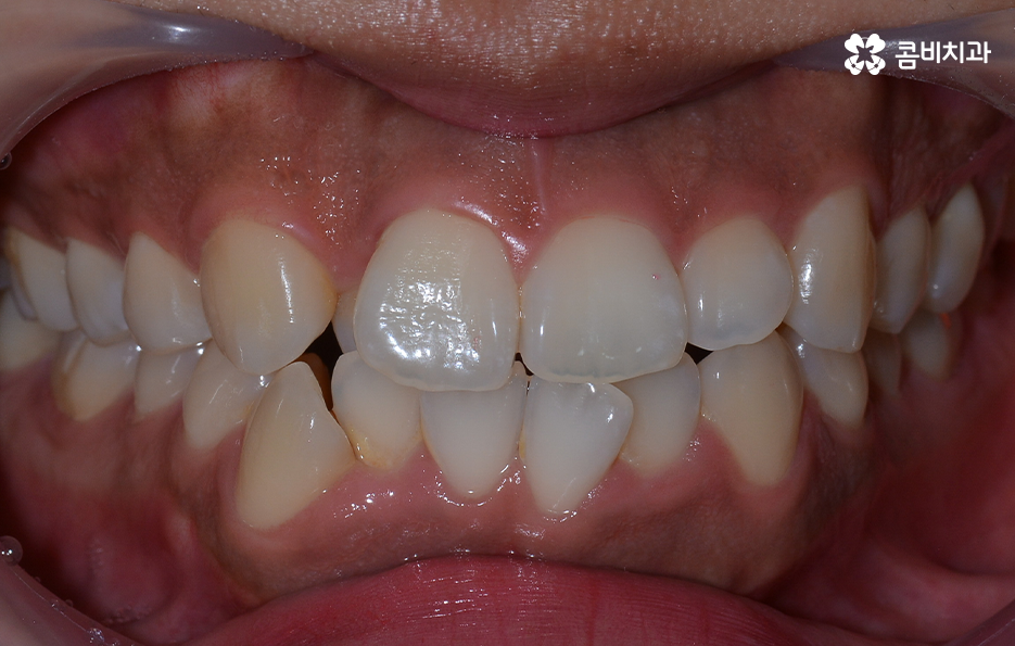 덧니 발치 교정 현명하게 선택하려면 관련 이미지 3