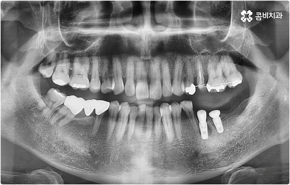 20대임플란트 남의일이 아니라면 관련 이미지 5