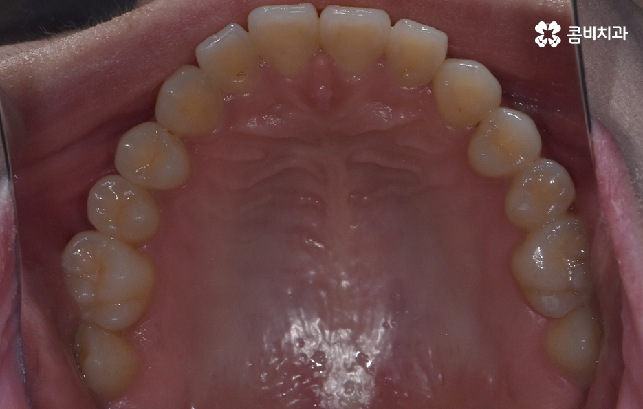 아래앞니 벌어짐 교정으로 해결했어요 관련 이미지 5