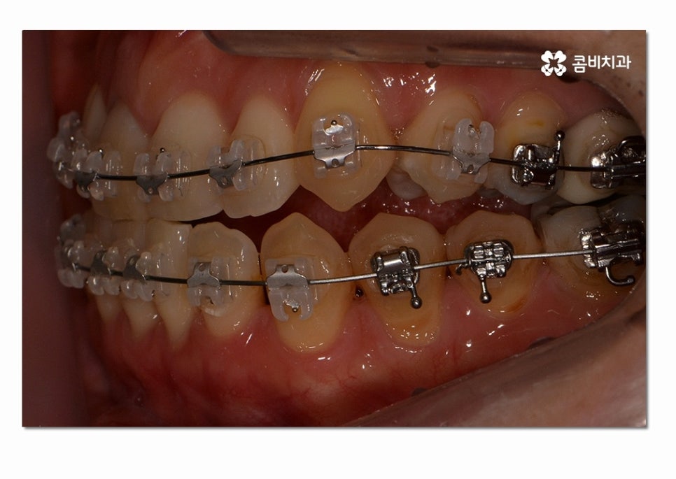 3급 부정교합 지금이라도 고치고 싶다면 관련 이미지 7
