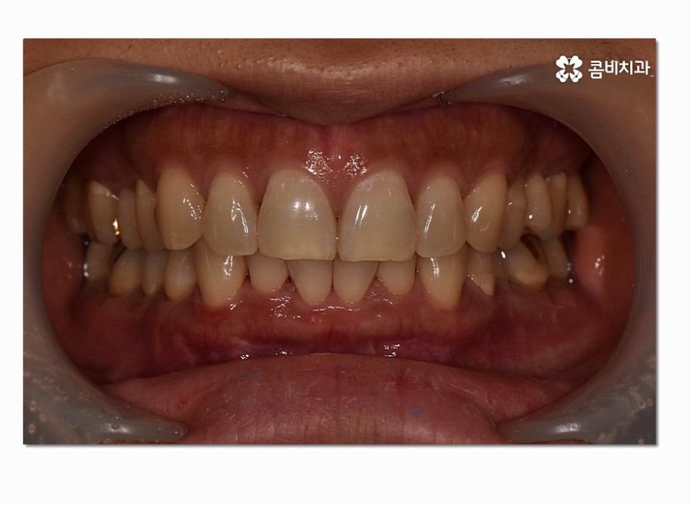 치아라미네이트 누구에게 필요할지 궁금하다면 관련 이미지 1
