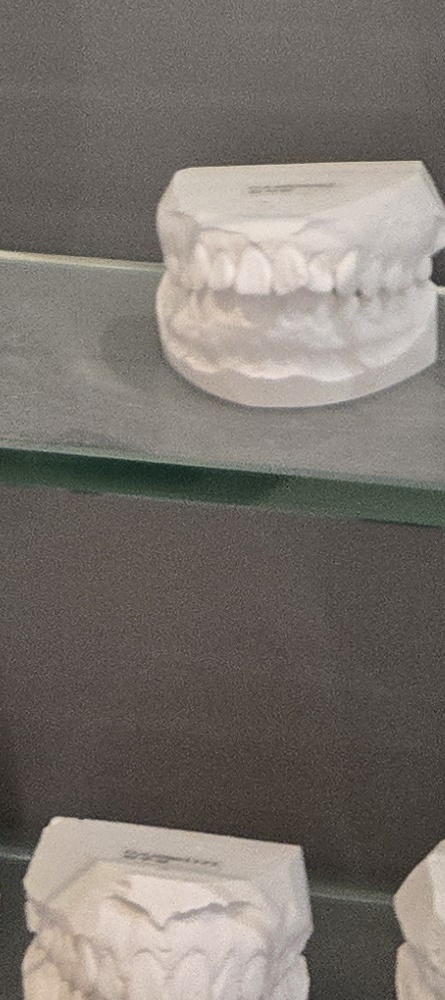 앞이빨 임플란트 과정 주의해야할 포인트는 관련 이미지 31