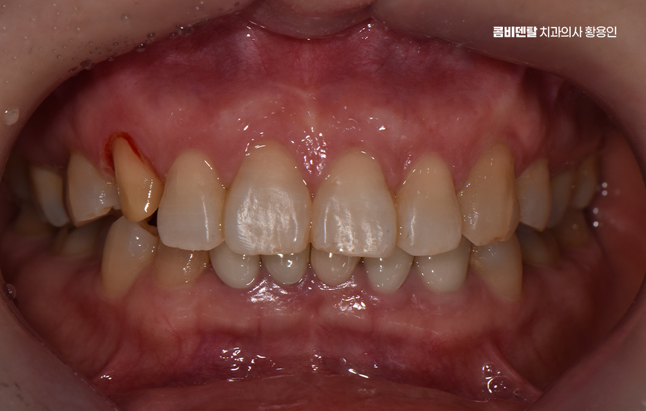 송곳니 크라운 티가 안나게 해결 가능한건가요 관련 이미지 5