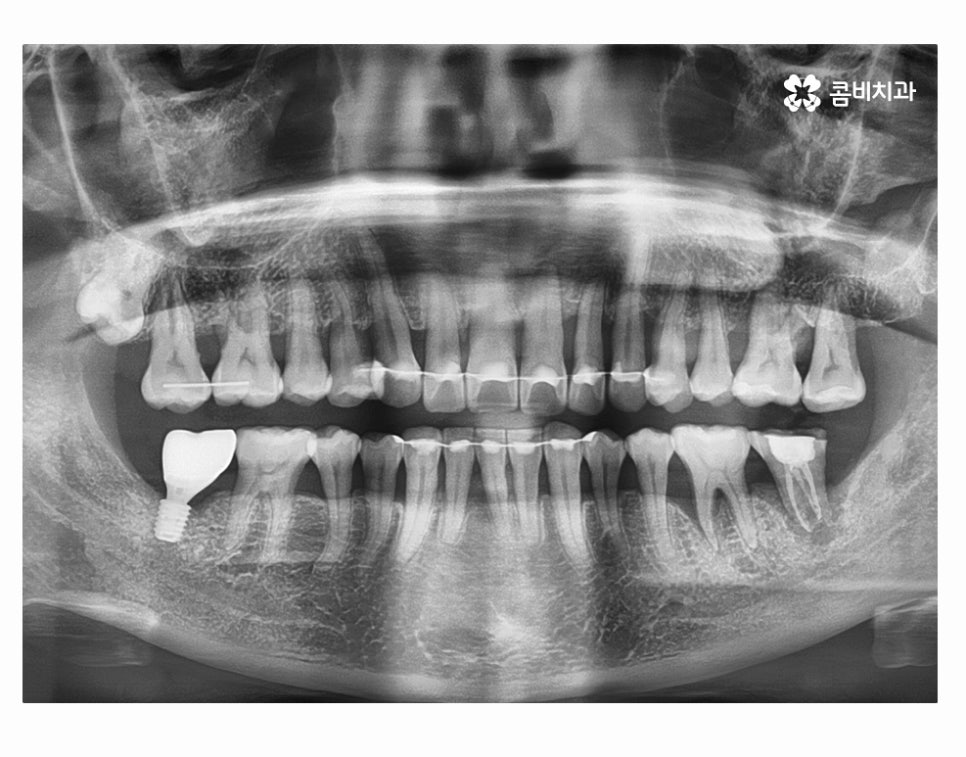 어금니 발치 심각해지기 전에 막으려면 관련 이미지 14