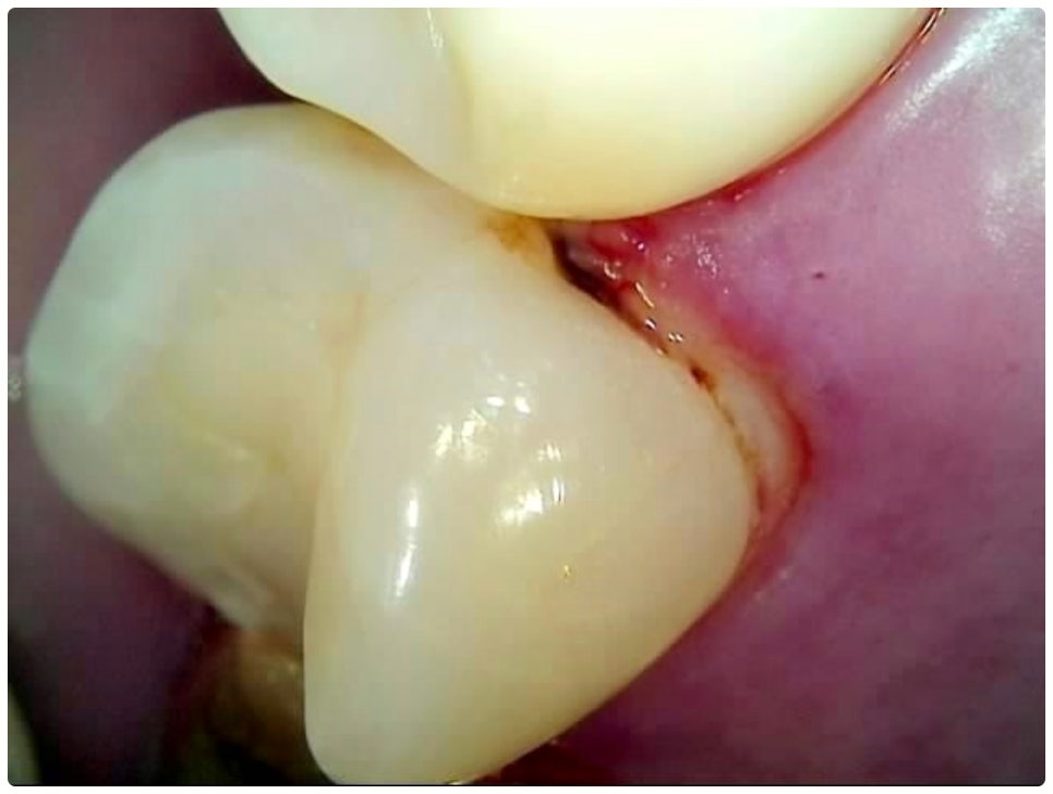 충치치료종류 알아볼까요? 관련 이미지 4