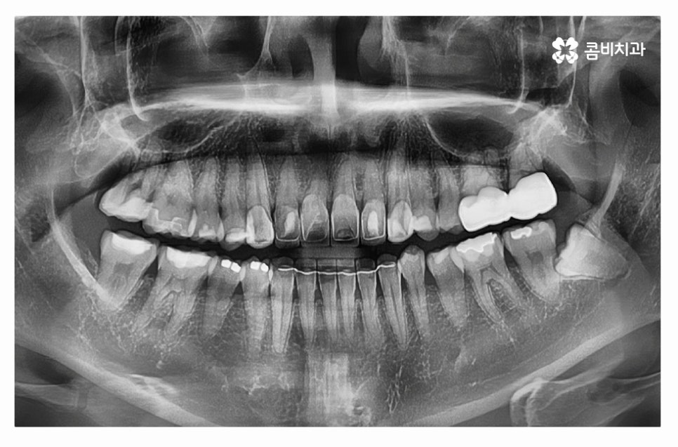 누운사랑니발치 언제 뽑을지 고민이라면 관련 이미지 7