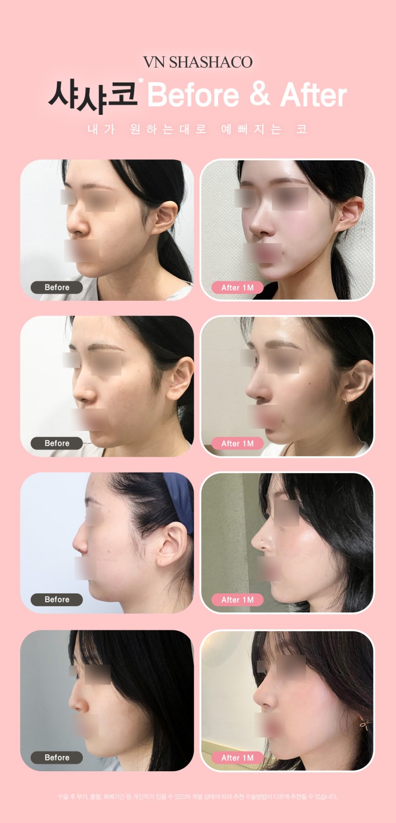 자가연골을 사용한 브이엔성형외과의 비개방코성형 샤샤코 관련 이미지 6