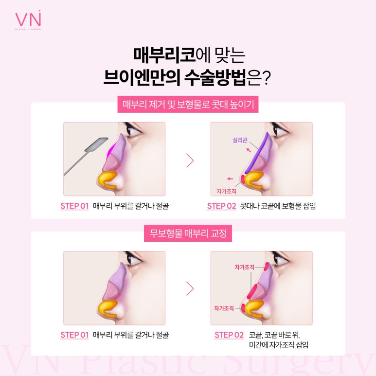 유형별로 알아보는 코수술, 나는 어떤 유형일까? 관련 이미지 3