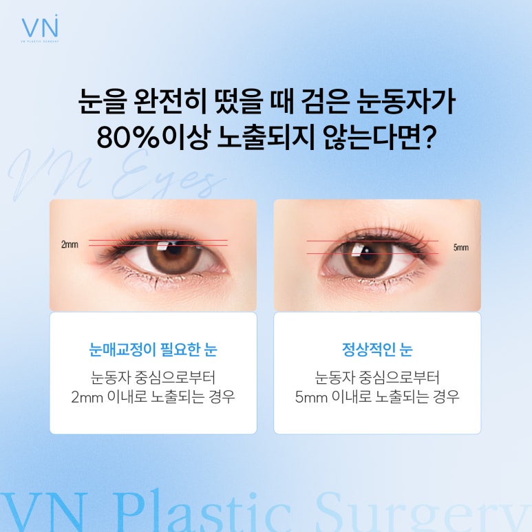 Eyelid Correction? The Difference Between Incisional and Non-Incisional Methods! image 2