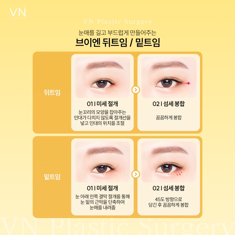 트임성형, 과하지 않고 자연스럽게 개선하는것이 포인트 관련 이미지 4