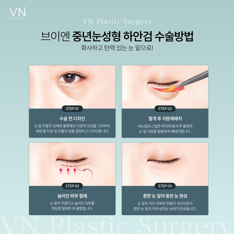 중년눈 성형 고민하고 있다면? 관련 이미지 3