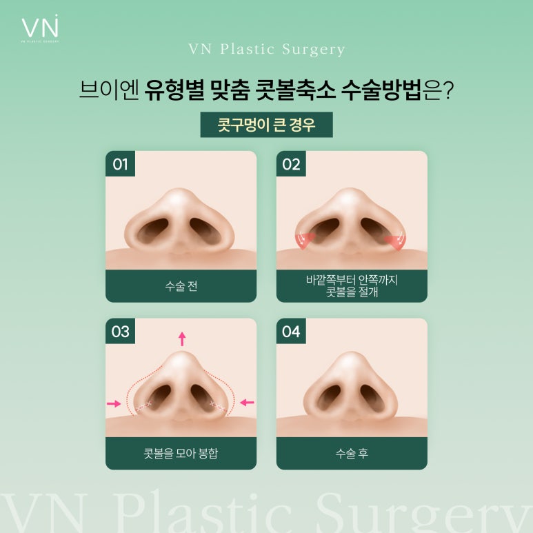Let’s Learn About Who Is a Candidate for Alar Reduction Surgery and the Surgical Methods! image 3