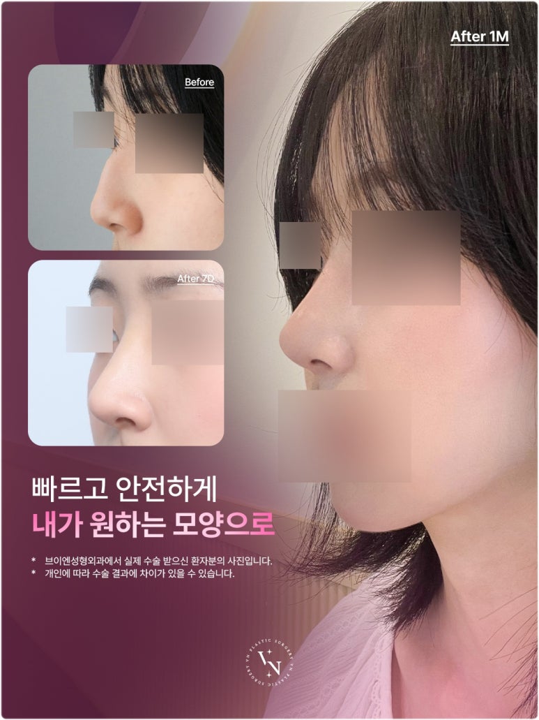Cartilage Particle Rhinoplasty (Shasha Nose): Why Finely Mince the Cartilage? image 3